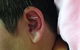 Acupuncture @ Beerwah - thumb 3