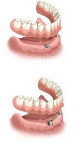 Precise Dentures – Blair Grundy Denture Clinic - Click Find 2